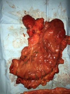 Total gastrectomy for carcinoma stomach