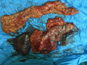 Total gastrectomy , omentectoy and splenectomy for CA stomach