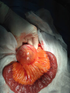 Total excision of large mesenteric cyst