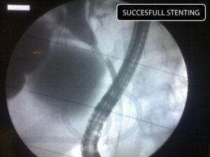 CBD injury during lap. chol. Roux en Y repair