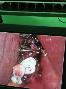 Caterpillar anomaly of cystic artery encountered during laparoscopic cholecystectomy