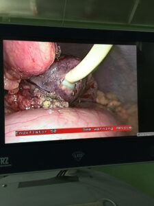 External drainage after laparoscopic removal of liver left lobe hydatid cyst