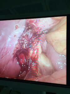 Floating gall bladder encountered during laparoscopic cholecystectomy