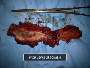 Ivor Lewis operation for lower esophageal carcinoma