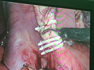 Laparoscopic appendectomy