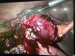 Laparoscopic (cholecystostomy) for severe empyema of gall bladder