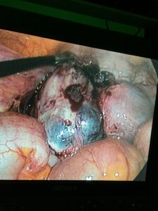 Laparoscopic salpingo oophorectomy for endometriosis