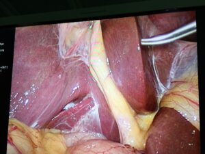 Laparoscopic view of Bouvier’s sulcus