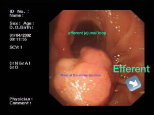 Large gastric hyperplastic polyp in site of surgical gasteroenterostomy