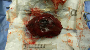 Resection of large liver haemangioma