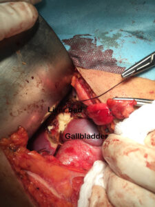 Hepatic mass resection by ligasure