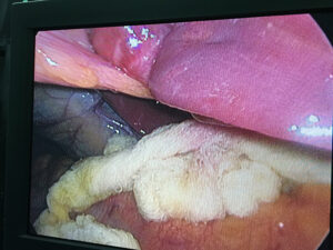 Laparoscopy for liver hydatid cyst