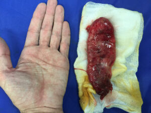 Largest gall bladder encountered during laparoscopic cholecystectomy