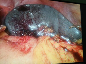 Three ports laparoscopic splenectomy