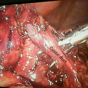 Fundus first laparoscopic cholecystectomy