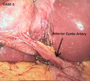 Anterior cystic artery encountered during laparoscopic cholecystectomy