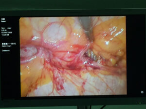 Laparoscopic view of Recurrent incisional hernia