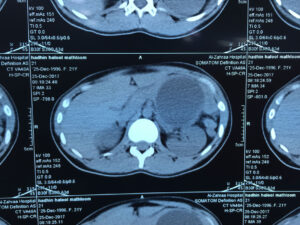 Laparoscopic Assisted Distal Pancreatectomy plus Splenectomy for Mucinous Cyst