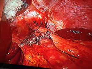 Laparoscopic Heller’s myotomy with Dor Funduplication