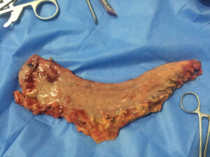 Laparoscopic Sleeve Gastrectomy