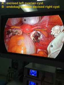 Laparoscopic bilateral DERMOID ovarian cystectomy