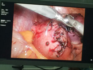 Laparoscopic myomectomy case 1