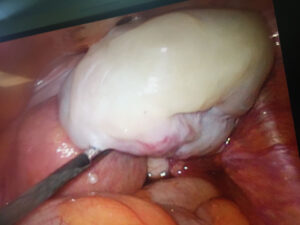 Laparoscopic myomectomy case 2