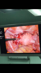 Laparoscopic myomectomy case 3