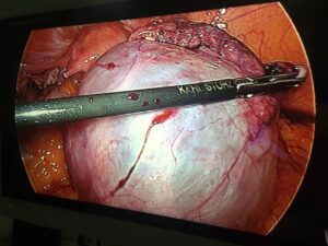 Laparoscopic ovarian cystectomy