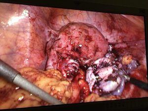 Laparoscopic salpingo oophorectomy- endometriosis