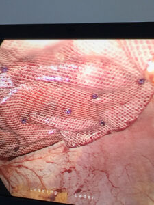 Laparoscopic ventral H repair using composite prolene collagen mesh