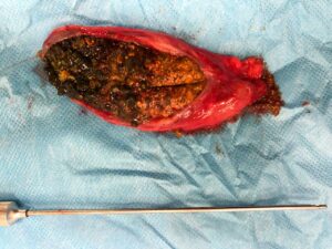 Large number of gallstones