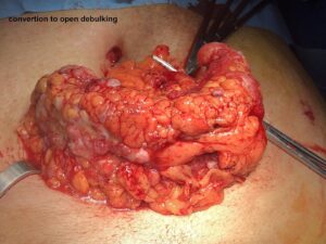 Peritoneal carcinomatosis