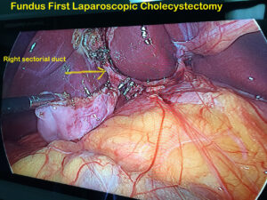 Right sectorial duct encountered during laparoscopic cholecystectomy