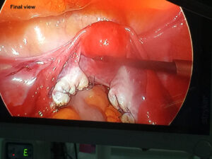 laparoscopic bilateral ovarian cystectomy