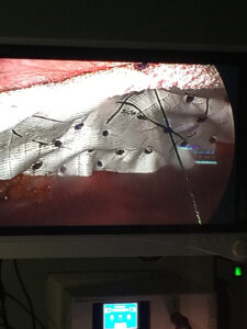 laparoscopic ventral hernia repair 3