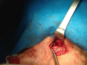 Total excision of left submandibular salivary gland