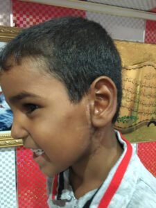 Parotidectomy for recurrent left parotid mass(neurofibroma of facial nerve) in male child patient