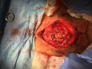 Anaplastic thyroid carcinoma total thyroidectomy and lymph node dissection