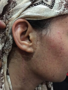 Total right parotidectomy for parotid haemangioma