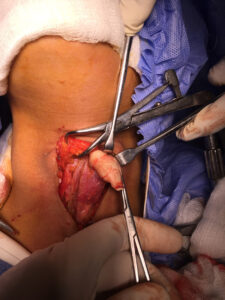 Dermoid cyst attached to thyroid gland