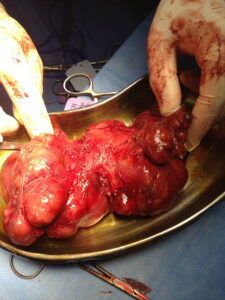 Near total thyroidectomy for very large mulinodular goiter