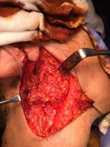 Right superficial parotidectomy for pleomorphic adenoma