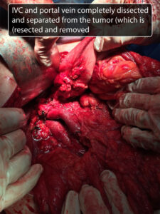 Whipple’s operation ( TOTAL pancreatecodoudenectomy) for pancreatic head mass in adult (middle aged) male