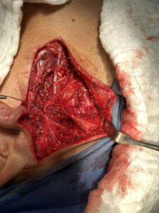 Left superficial parotidectomy