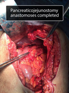 Whipple’s operation (pancreatecodoudenectomy) for periampullary carcinma in young adult male