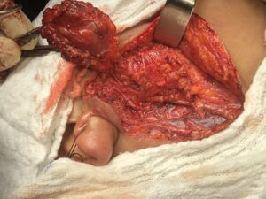 Right Parotidectomy