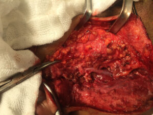 Right Superficial Parotidectomy