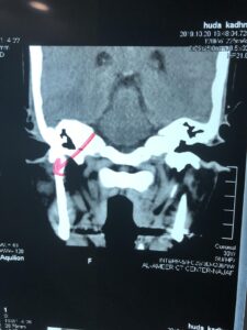 Right superficial Parotidectomy for Adenoma