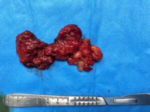 Right superficial parotidectomy